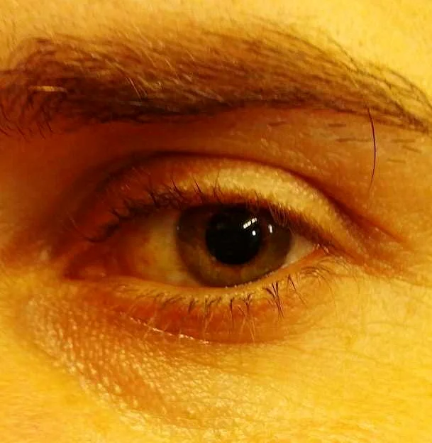 Основные методы устранения желтых белков глаз