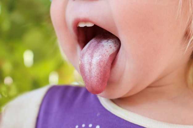 Белый налет на корне языка: почему возникает и что это?
